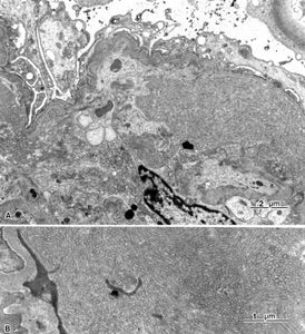 電子顕微鏡アトラス　腎生検　renal biopsy