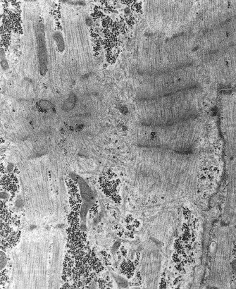 电子显微镜图谱 心内膜下心肌活检 心内膜心肌活检