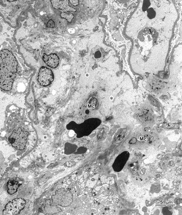 電子顕微鏡アトラス 腎生検 renal biopsy – Nisshin-EM