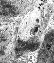 画像をギャラリービューアに読み込む, 電子顕微鏡アトラス　心内膜下心筋生検　endomyocardial biopsy
