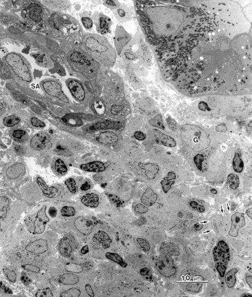 电子显微镜图谱肾活检