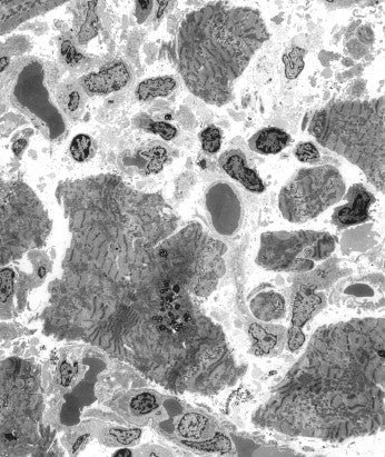 电子显微镜图谱 心内膜下心肌活检 心内膜心肌活检