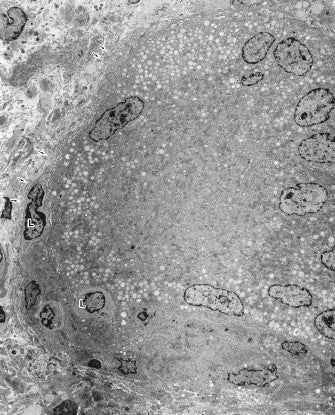 电子显微镜图谱 心内膜下心肌活检 心内膜心肌活检